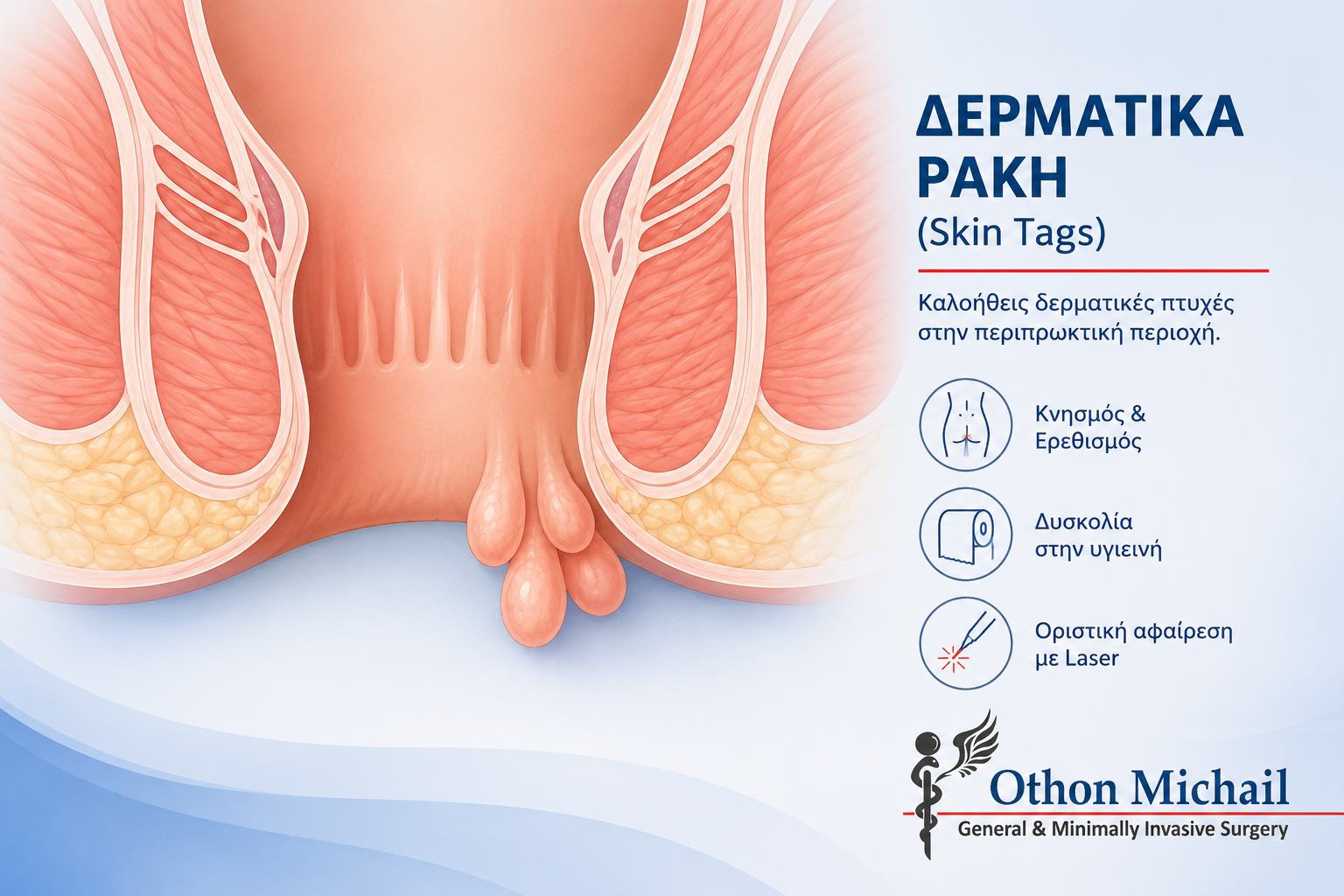 Δερματικά ράκη (skin tags) στην περιπρωκτική περιοχή και αντιμετώπιση με Laser