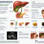 ΧΟΛΗΔΟΧΟΛΙΘΙΑΣΗ Ιατρικό infographic για τη χοληδοχολιθίαση με συμπτώματα, διάγνωση και θεραπεία με ERCP.