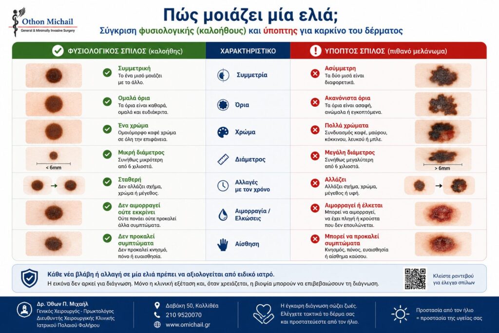 Σύγκριση φυσιολογικού σπίλου και ύποπτου σπίλου για καρκίνο του δέρματος με βάση τη συμμετρία, τα όρια, το χρώμα, τη διάμετρο και τις αλλαγές με τον χρόνο.